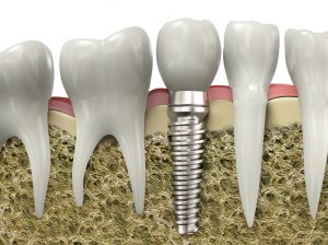 Learn more about the procedure for dental implants in Los Fresnos.